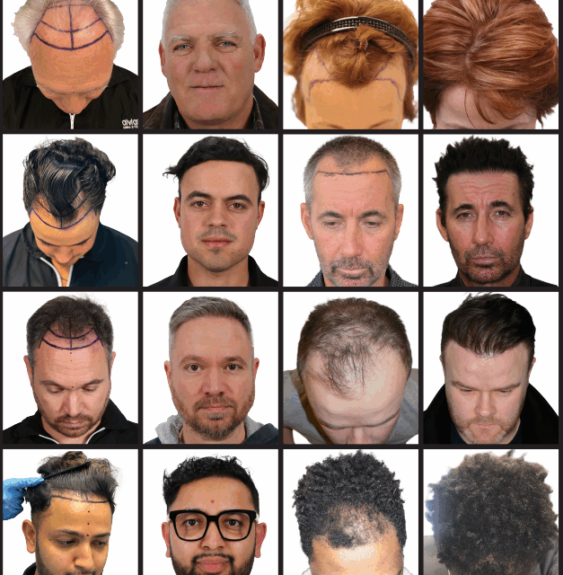 Armani FUE Hair Transplant Deposit