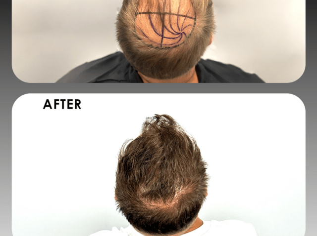 How Many Grafts Do You Need? Hair Graft Calculator Guide – Alvi Armani South Africa How Many Grafts Do You Need? Hair Graft Calculator Guide – Alvi Armani South Africa